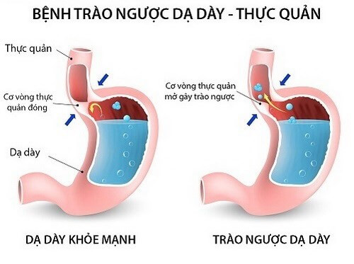 trào ngược dạ dày thực quản